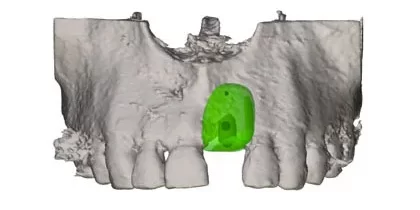 Mit 3D-Technologie zum perfekten Knochenaufbau für den Kiefer– frisch aus der Fräsmaschine