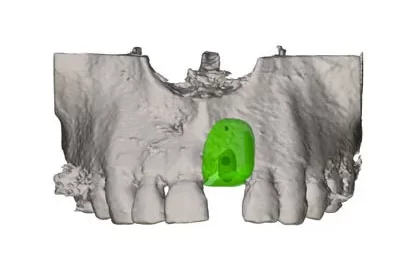 blog-knochenblock-dr-marc-hinze-1.jpg Mit 3D-Technologie zum perfekten Knochenaufbau für den Kiefer– frisch aus der Fräsmaschine