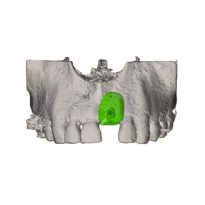 blog-knochenblock-dr-marc-hinze-1.jpg Mit 3D-Technologie zum perfekten Knochenaufbau für den Kiefer– frisch aus der Fräsmaschine