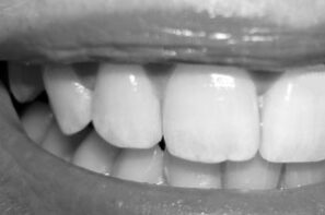 blog-frontzahn-implantat-dr-marc-hinze-muenchen-1