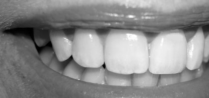 blog-frontzahn-implantat-dr-marc-hinze-muenchen-1