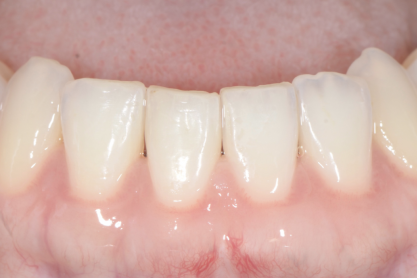 Blog-Zahnfleischkorrektur-implanteer-640×278