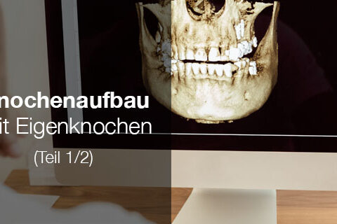 web-knochenaufbau-1-implanteer