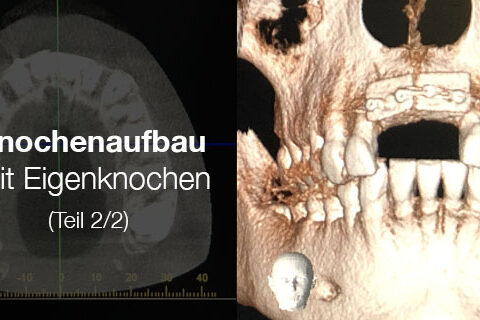 web-knochenaufbau-2-implanteer
