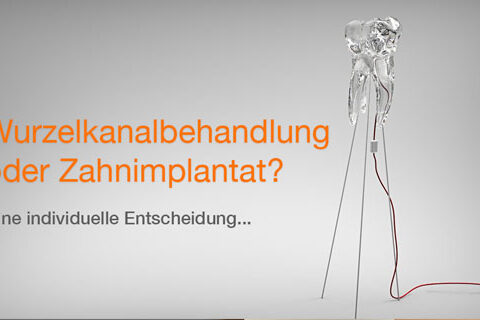 web-wurzelbehandlung-vs-implantat