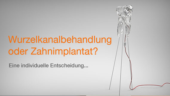 web-wurzelbehandlung-vs-implantat