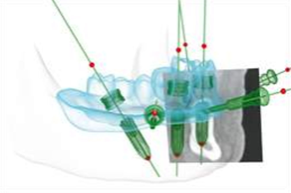 Veranschaulichung Implantate Bohrung