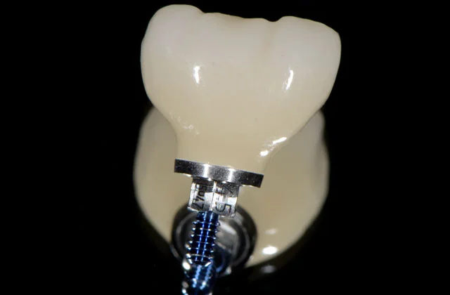 Zahnmaterial Zirkonoxid in München – Implanteer