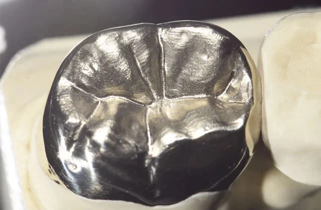 Zahnmaterial Gold in München – Implanteer
